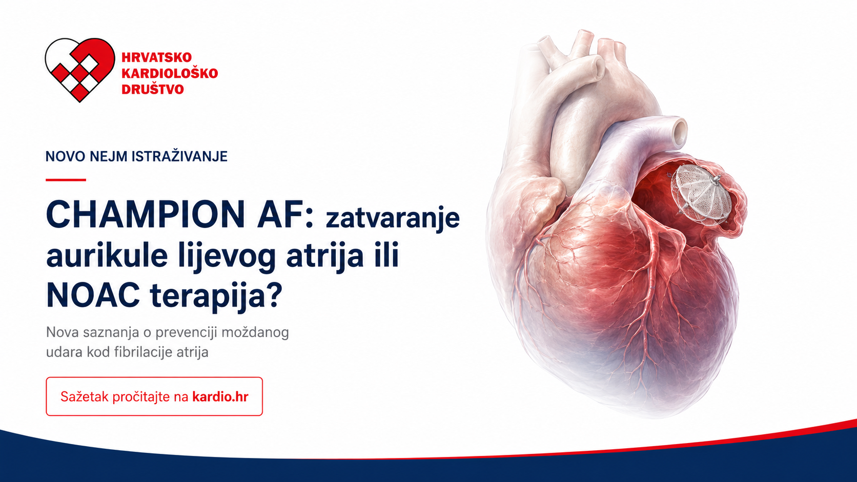 Zatvaranje aurikule lijevog atrija kao alternativa antikoagulantnoj terapiji kod fibrilacije atrija