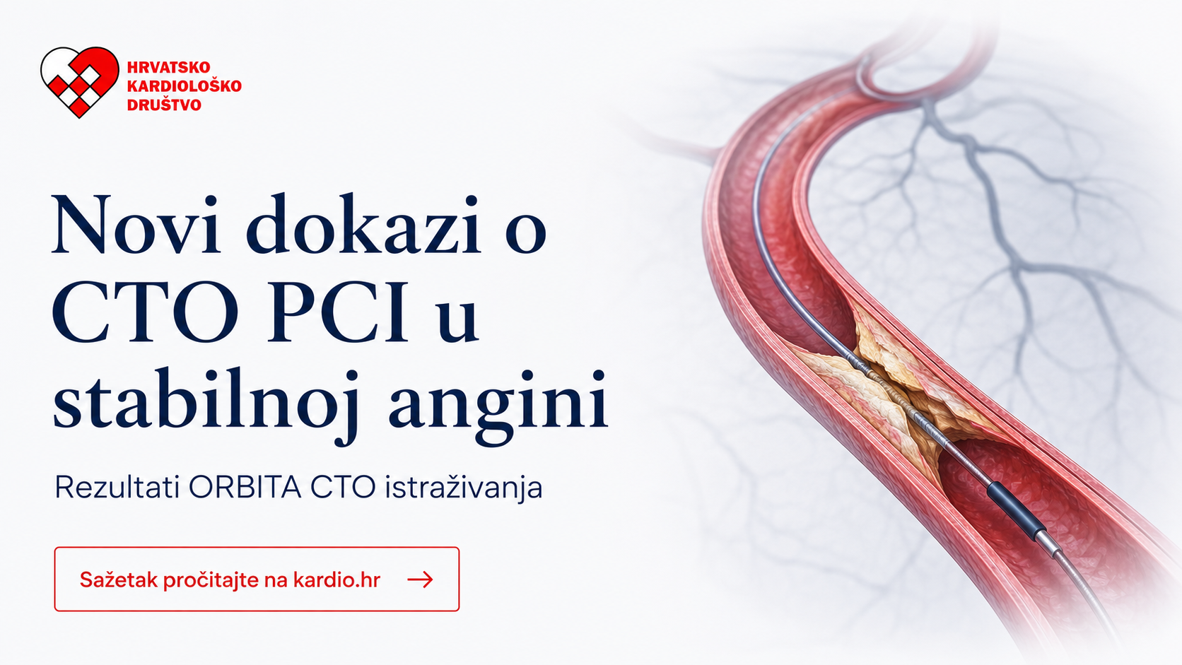 ORBITA-CTO: Ima li PCI opipljivu ulogu u kroničnoj totalnoj okluziji?